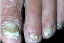 灰指甲的病因